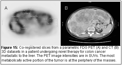 Text Box: Figure 15: Co-registered slices from a parametric FDG PET (A) and CT (B) 3D datasets in a patient undergoing novel therapy for colon cancer metastatic to the liver. The PET image intensities are in SUVs. The most metabolically active portion of the tumor is at the periphery of the masses.