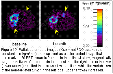 Text Box: Figure 19: Patlak parametric images (KPAT = net FDG uptake rate constant in ml/gm/min) are displayed as a color-coded image that summarizes 30 PET dynamic frames. In this clinical study, magnetically targeted delivery of doxorubicin to the lesion in the right lobe of the liver (lower arrows) resulted in decreased metabolism, while the metabolism of the non-targeted tumor in the left lobe (upper arrows) increased.