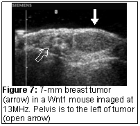 Breast Tumor