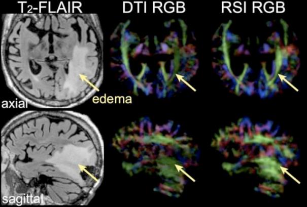 high-grade glioma left occipital lobe