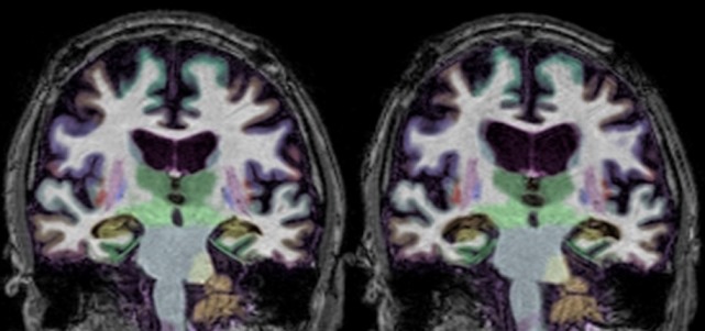 MRI brain memory structure